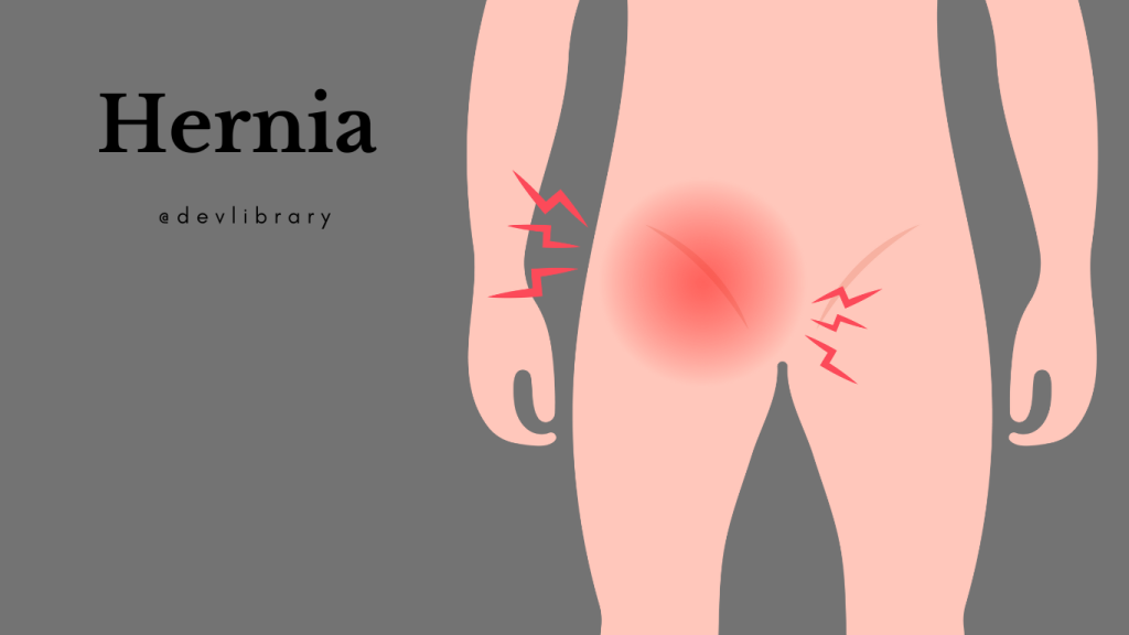 Hernia Problem | হাৰ্ণিয়া সমস্যা