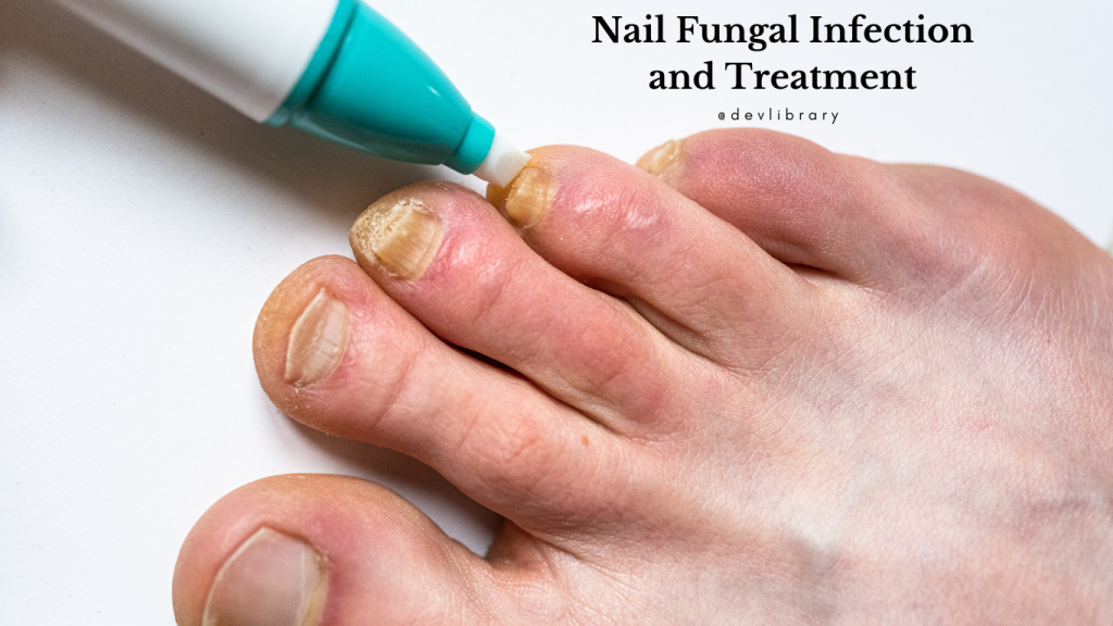 Nail Fungal Infection and Treatment | নখৰ ভেঁকুৰ সংক্ৰমণ  আৰু প্ৰতিকাৰ
