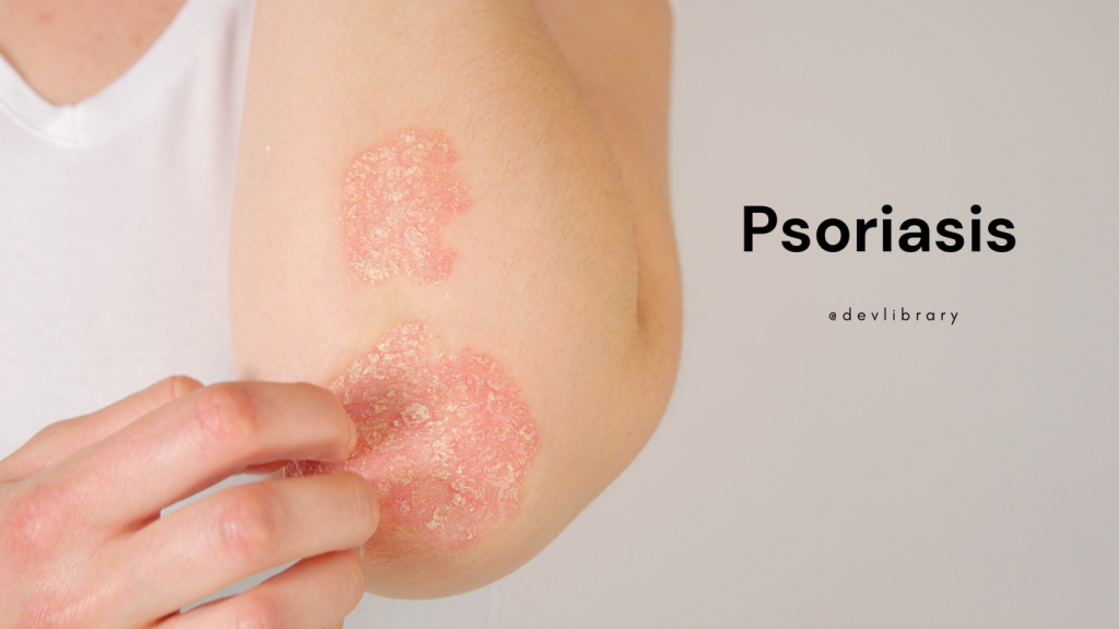 Psoriasis Problem and Treatment | চৰিয়েচিছৰ সমস্যা আৰু প্ৰতিকাৰ