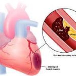 Antiplatelet Therapy