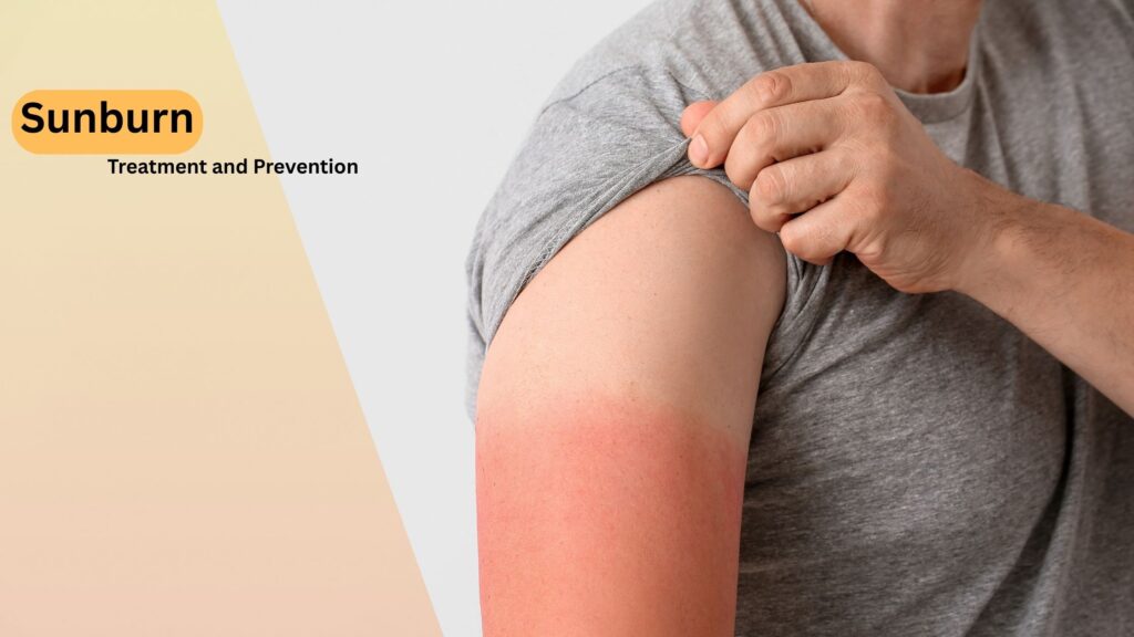 Sunburn Causes Symptoms Treatment and Prevention